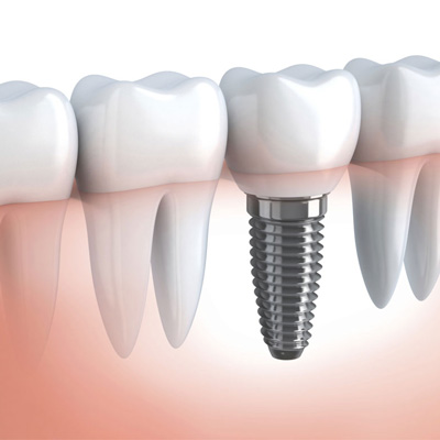 Dental Implants | Nova Prosthodontics