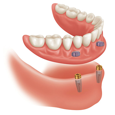 dentures Prosthodontics Dentist Fairfax VA 22030