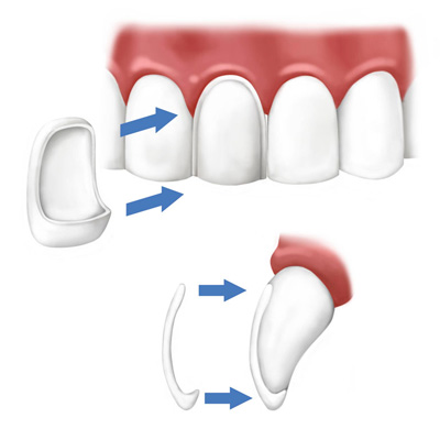 Dental Veneers Crowns Bridges | Nova Prosthodontics