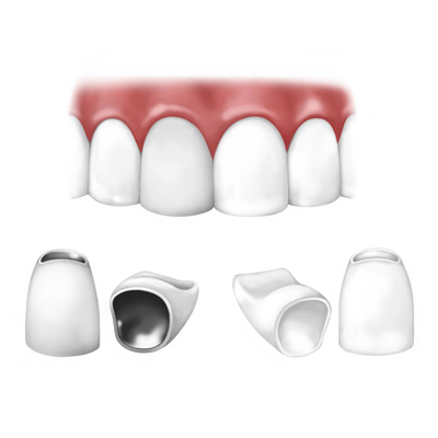 dental crowns | nova prosthodontics fairfax VA